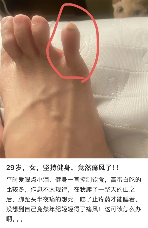 im钱包app官方下载:第一批95后 已经开始痛风了  第1张